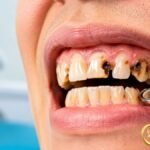 Rotten Teeth