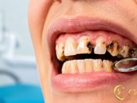 Rotten Teeth
